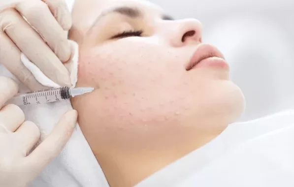 Zabieg mezoterapia igłowa - Salon Medycyny Estetycznej Wrocław Meso Skin Expert