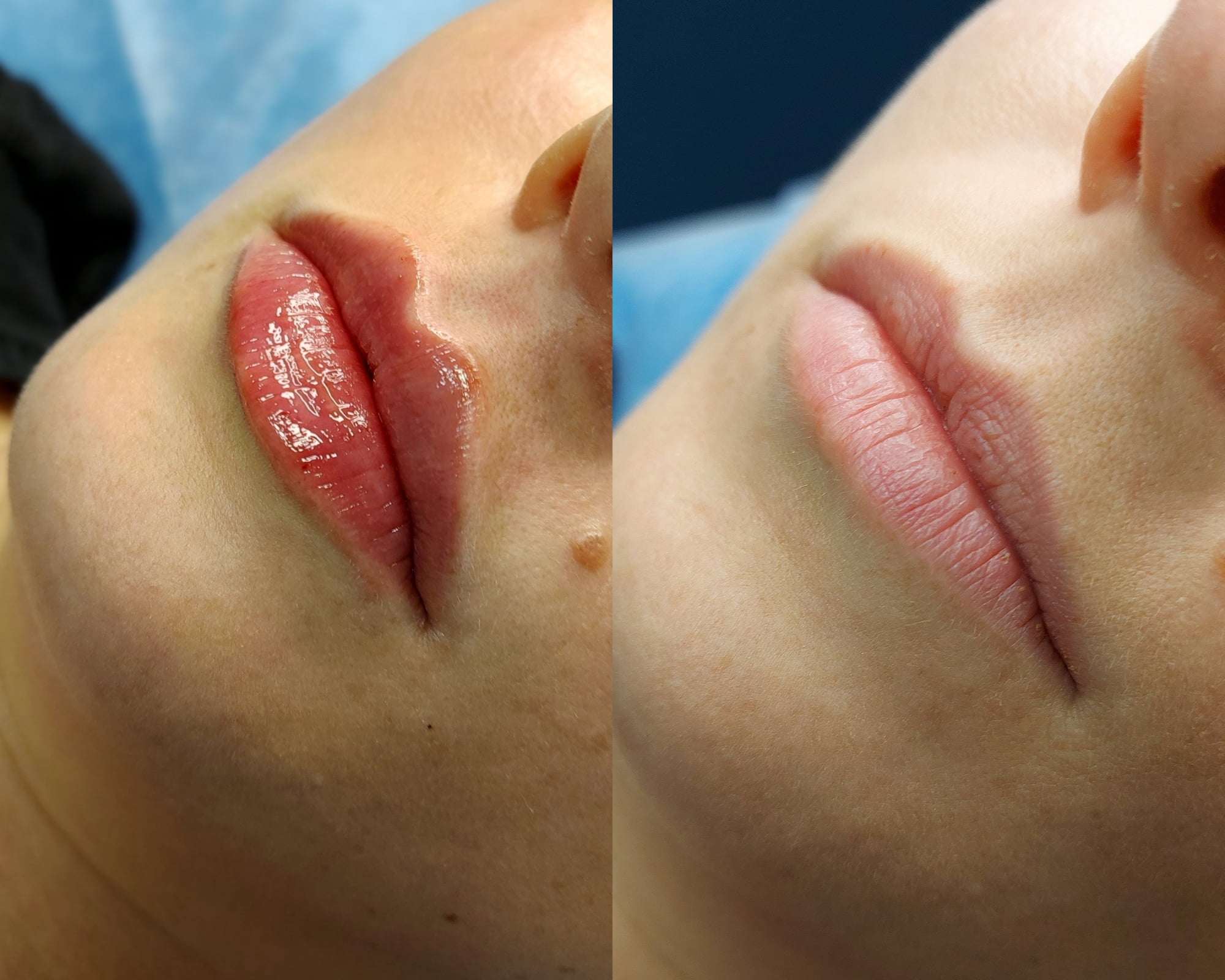 Naturalne nieprzerysowane efekty zabiegu modelowanie ust - Salon Medycyny Estetycznej Wrocław Meso Skin Expert