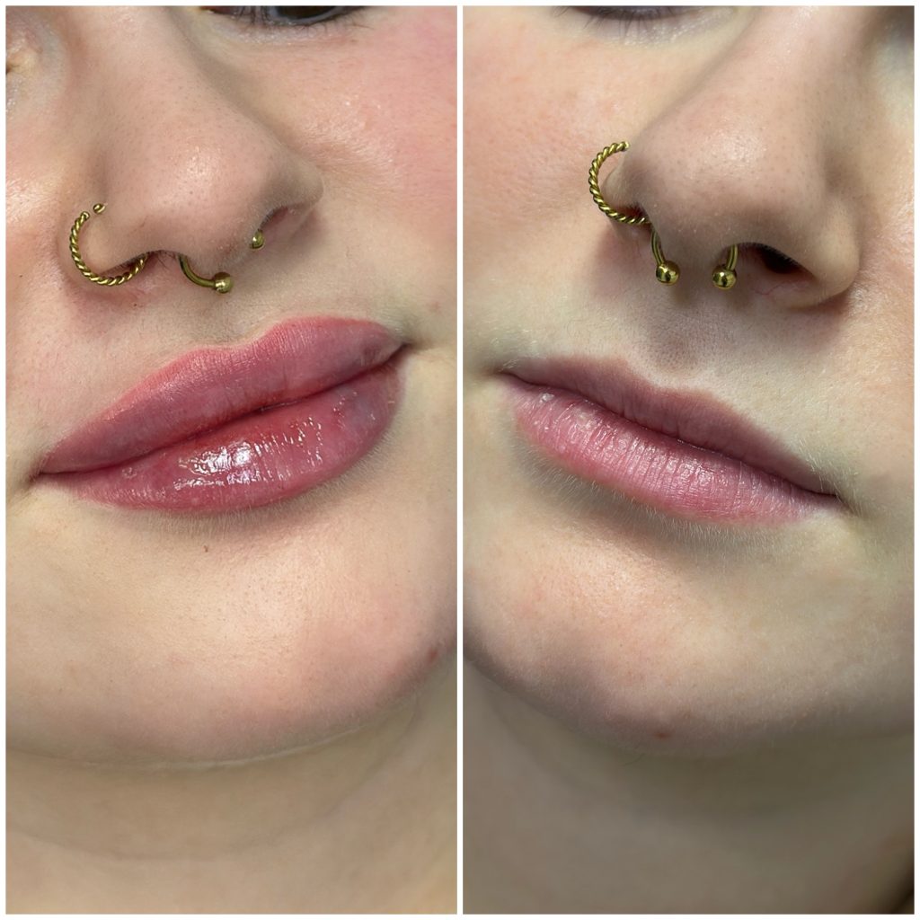 Naturalny nieprzerysowany efekty zabiegu naturalne modelowanie ust