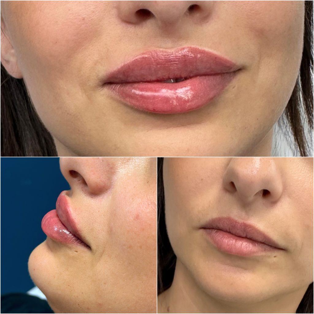 Efekty zabiegu naturalne modelowanie ust - modelowanie ust bez przerysowania