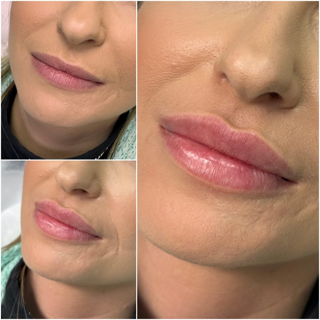 modelowanie ust – naturalny efekt przed i po